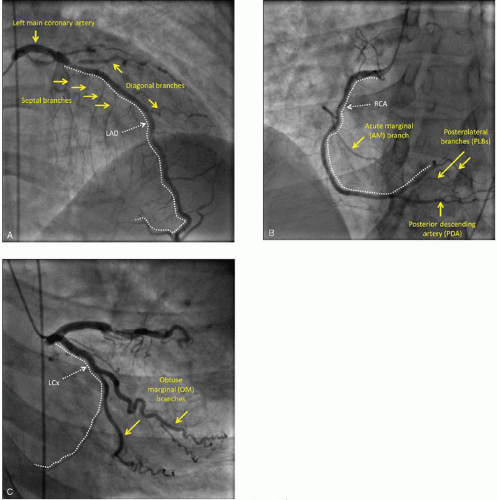 Cardiac Catheterization and Percutaneous Intervention | Thoracic Key