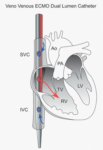 Extracorporeal Membrane Oxygenation in Infants and Children | Thoracic Key
