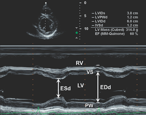 Assessment of Systolic Function and Quantification of Cardiac Chambers | Thoracic Key