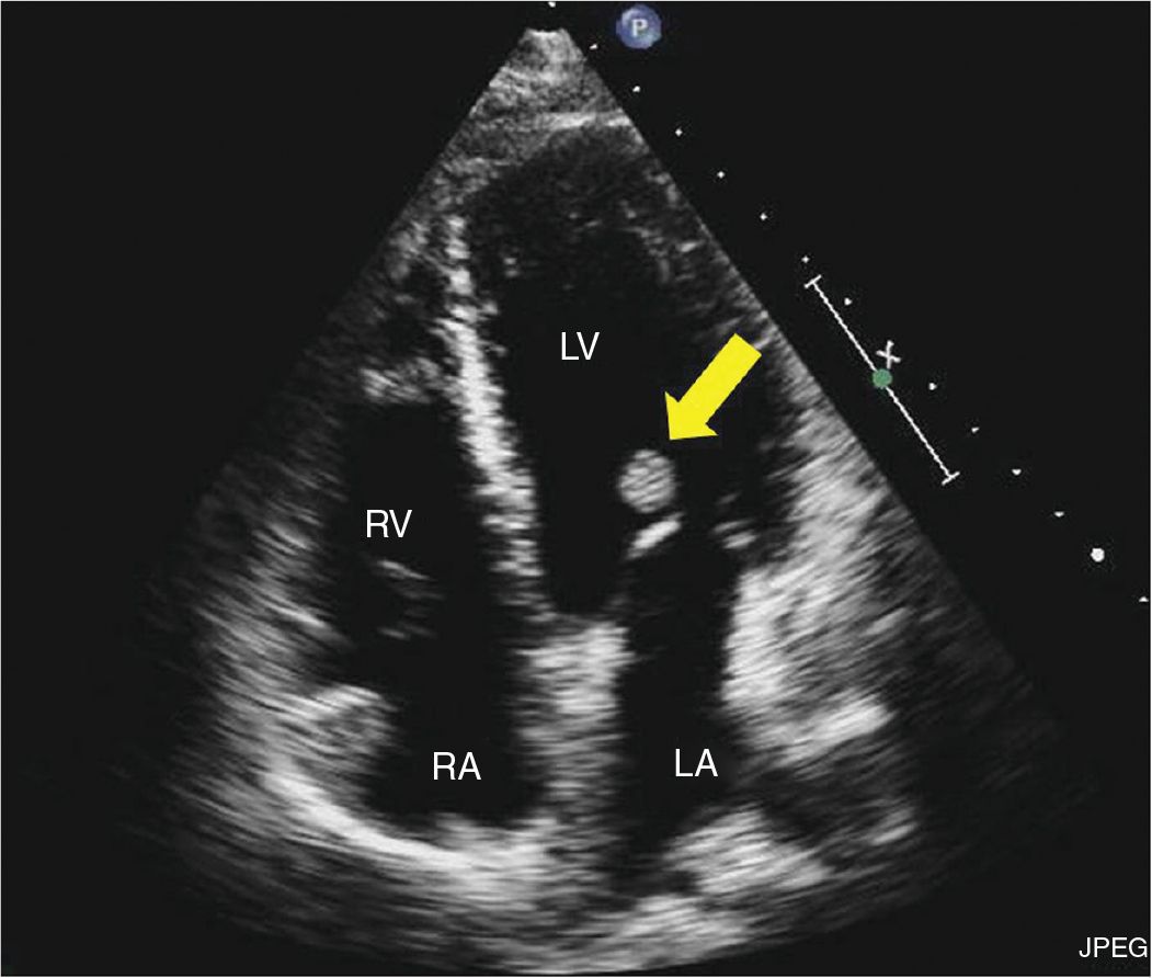 Echocardiography in the Evaluation of Intracardiac Masses | Thoracic Key
