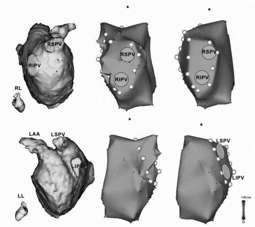 Circumferential Ablation With Pv Isolation Guided By Lasso Catheter