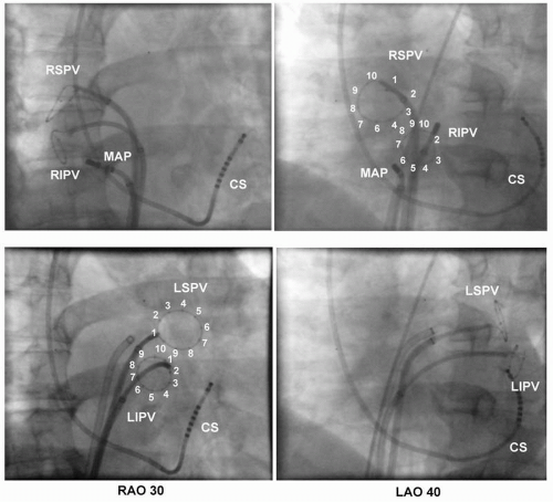 Circumferential Ablation With Pv Isolation Guided By Lasso Catheter