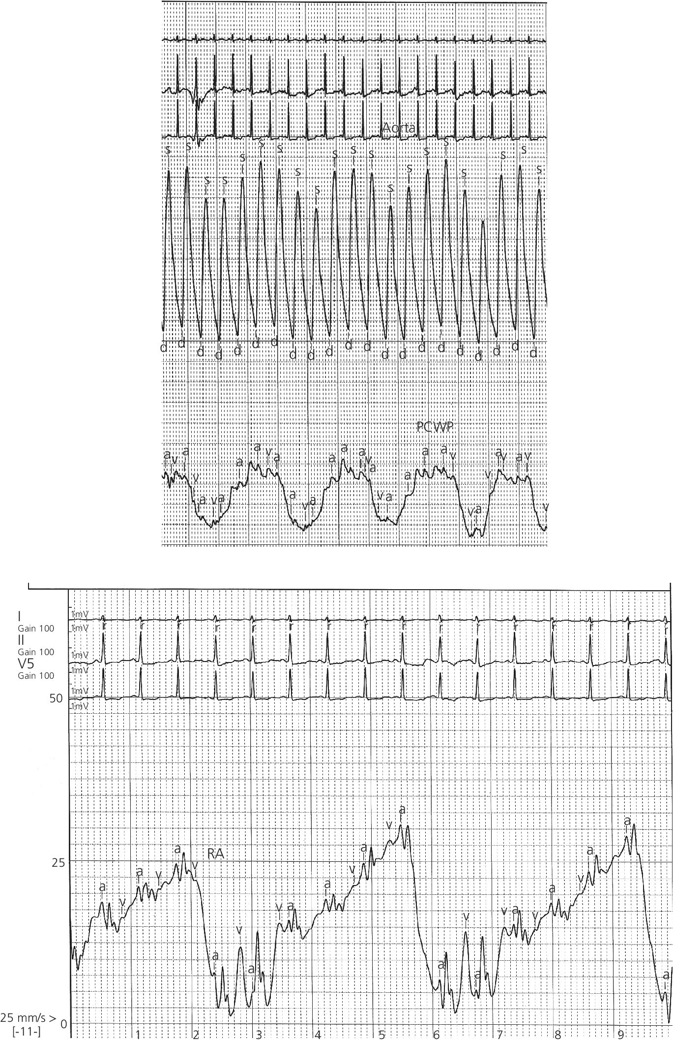 2 Electrocardiogram illustrating the effect of respiratory variation on RA and PCW pressures.
