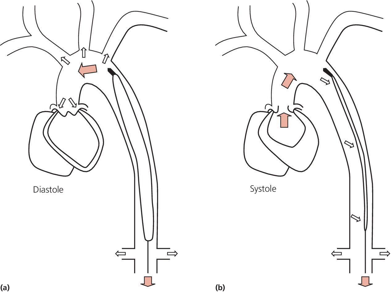 Two illustrations of IABP inflation labeled Diastole (left) and deflation labeled Systole (right).