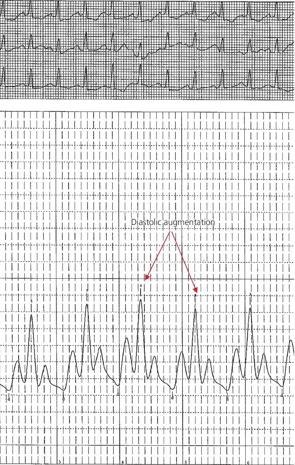 2 Electrocardiograms illustrating the IABP set on a 1:2 ratio in a 60-year-old male with cardiogenic shock in the setting of acute myocardial infarction (200 mm Hg scale).