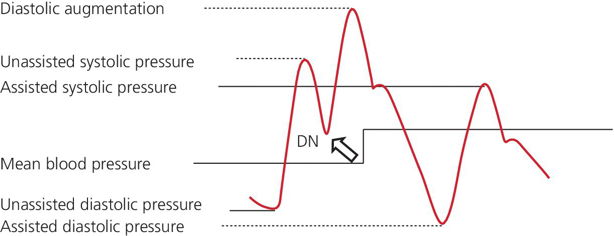 Waveform illustrating the correct IABP timing and hemodynamic effects, with normal timing of the IABP depicted by an arrow and DN label depicting dicrotic notch.