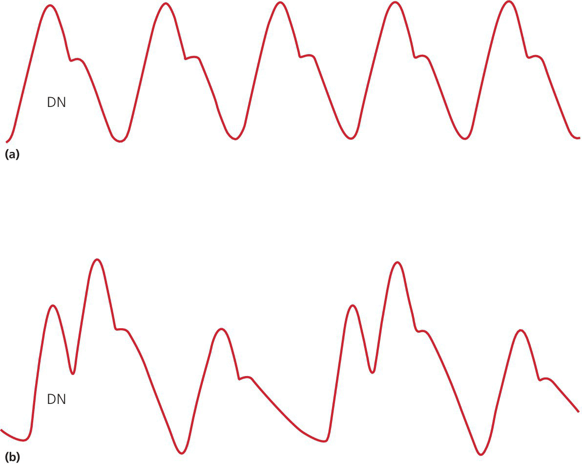 Aortic pressure waveforms before (top) and after (bottom) initiation of IABP at 1:2 ratio depicting aortic pressure with and without IABP.