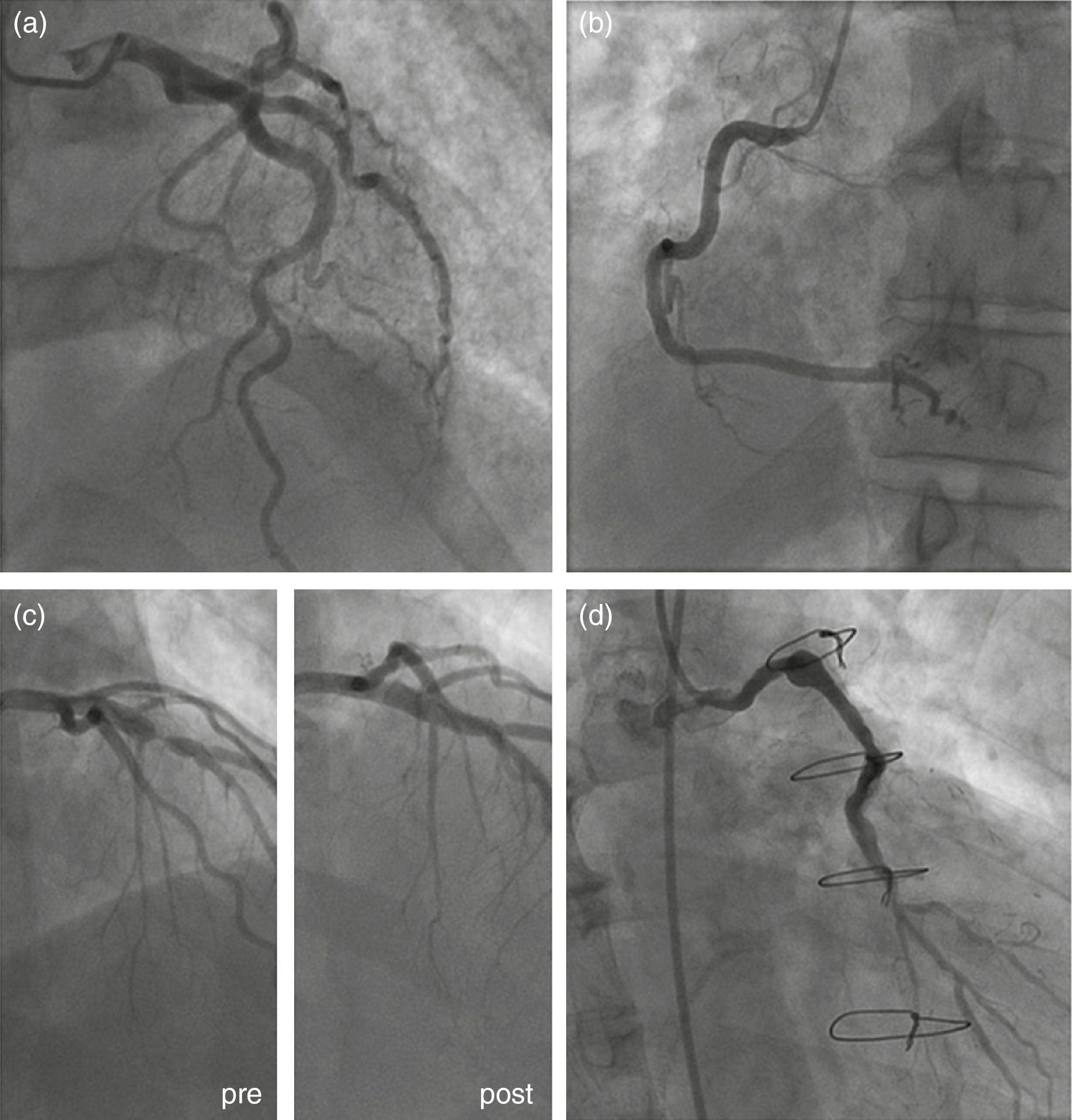 4-coronary-angiography-thoracic-key