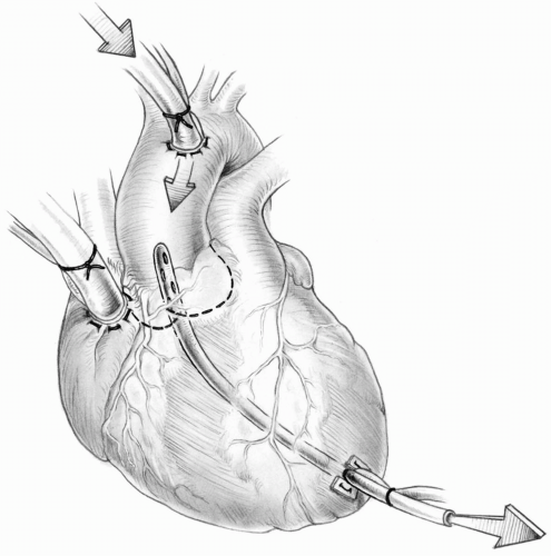 Venting and Deairing of the Heart | Thoracic Key