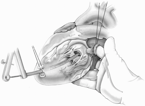 Surgery of the Mitral Valve Thoracic Key