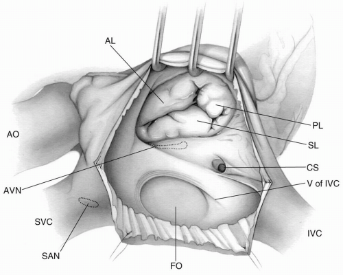 Анатомия хирургия. Tricuspid Valve leaflets.