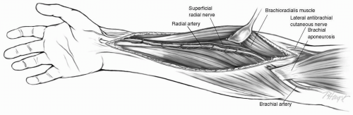 Surgery for Coronary Disease | Thoracic Key