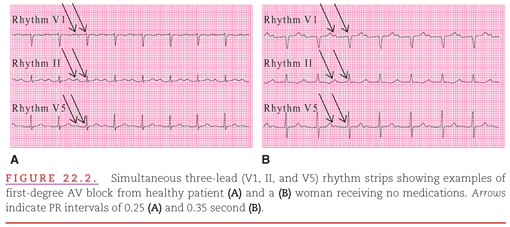 Atrioventricular Block Thoracic Key