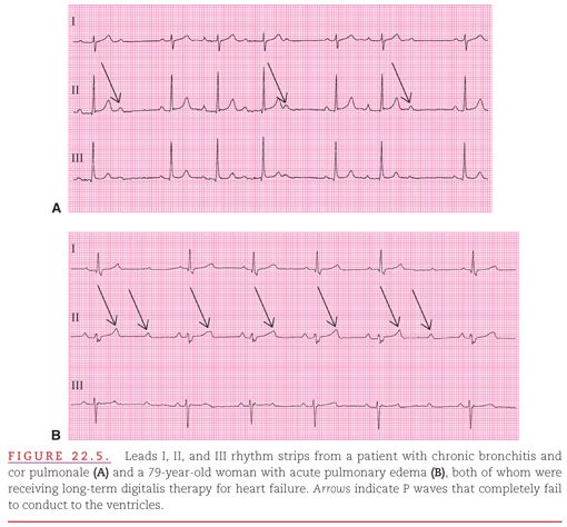 Atrioventricular Block Thoracic Key