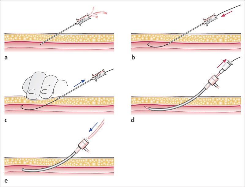 Arterial and Venous Access | Thoracic Key