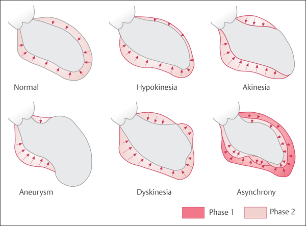 Catheterization of the Cardiac Chambers | Thoracic Key