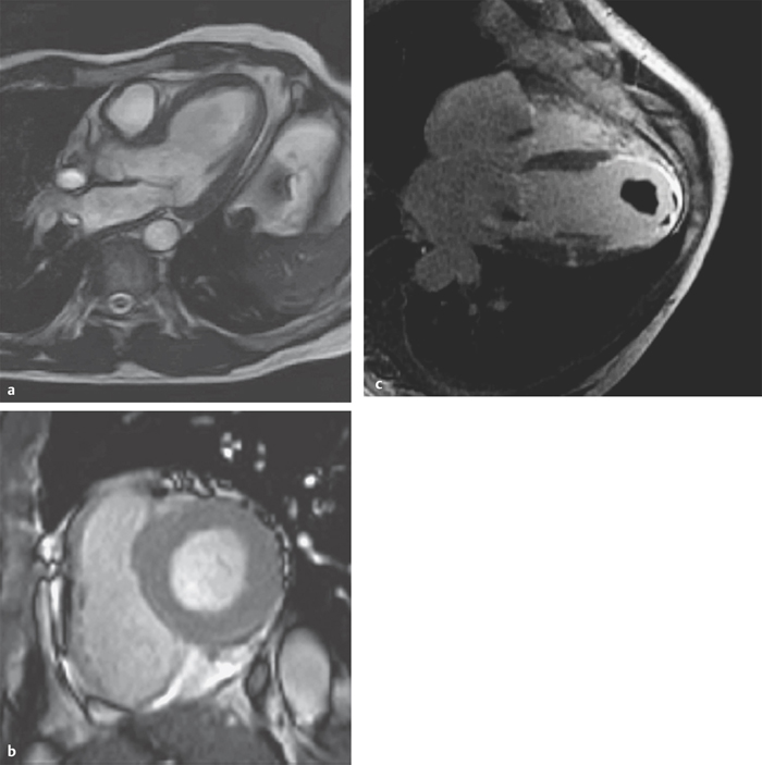 Catheterization Of The Cardiac Chambers | Thoracic Key