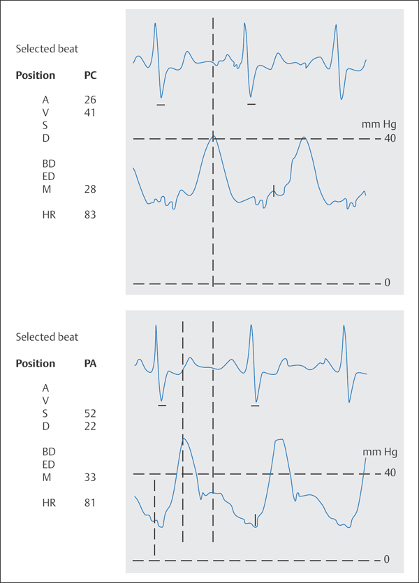 Hemodynamics | Thoracic Key