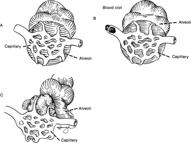 alveolar dead space vs physiological dead space vs physiological shunt