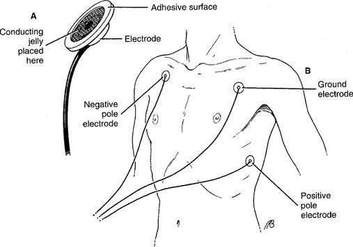 cardiac monitor lead placement