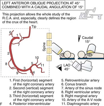 aortic arch angiogram cpt code