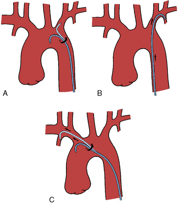 Percutaneous Mitral Commissurotomy And Balloon Aortic Valvuloplasty ...