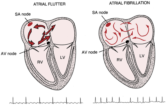 Supraventricular Arrhythmias, Part II: Atrial Flutter and ...