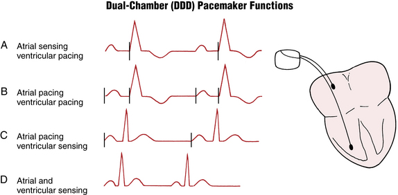 pacemaker-sensing