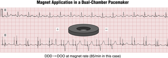 Pacemakers And Implantable Cardioverter-Defibrillators: Essentials For ...