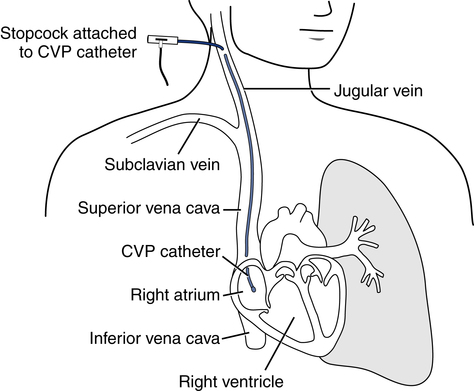 Vascular Pressure Monitoring | Thoracic Key