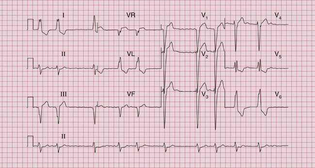 ecg 23