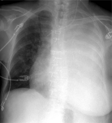 Chest Radiography | Thoracic Key