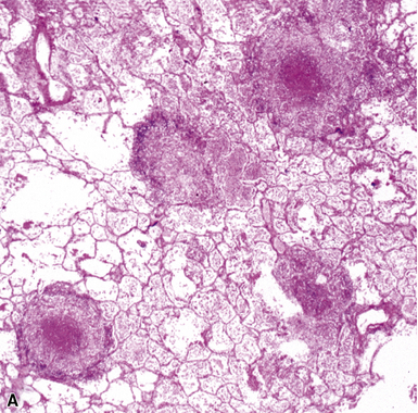 miliary tuberculosis histology