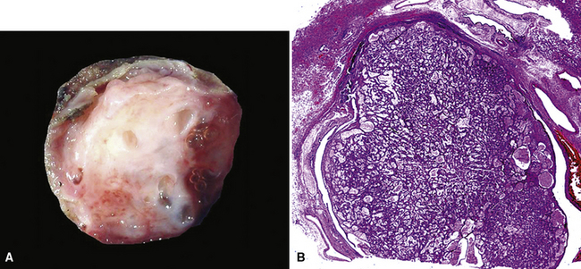 Benign And Borderline Tumors Of The Lungs And Pleura Thoracic Key