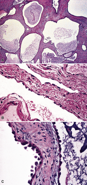 Malignant And Borderline Mesothelial Tumors Of The Pleura | Thoracic Key