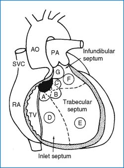 Congenital Heart Defects | Thoracic Key