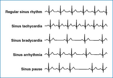 Arrhythmias And Atrioventricular Conduction Disturbances Thoracic Key