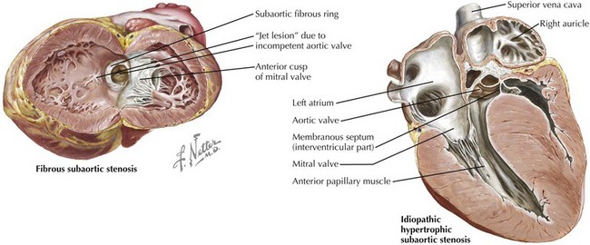 Hypertrophic Cardiomyopathy Thoracic Key