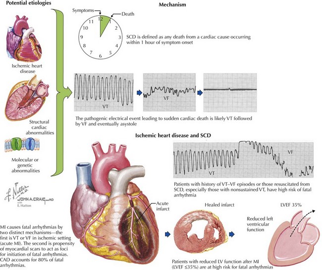 Sudden Cardiac Death | Thoracic Key