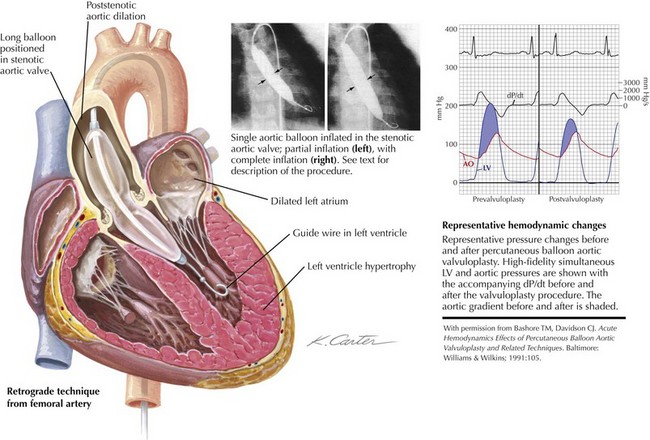 Percutaneous Catheter-based Therapy for Valvular Heart Disease ...