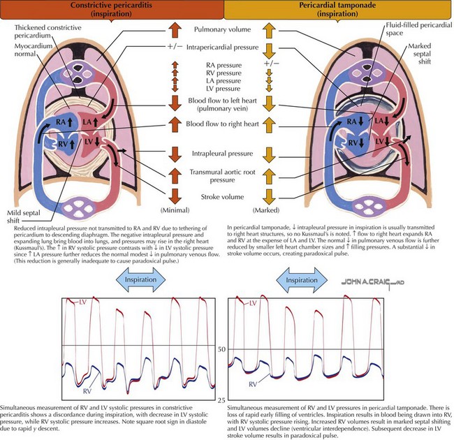 Pericardial Disease: Diagnosis And Hemodynamics | Thoracic Key