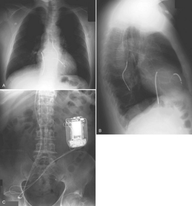 Imaging Of Implantable Devices Thoracic Key 