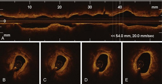 icd 10 pcs code for optical coherence tomography