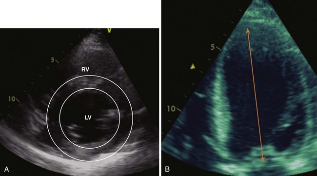 Distinguishing Systolic versus Diastolic Heart FailureA Practical Approach by Echocardiography ...
