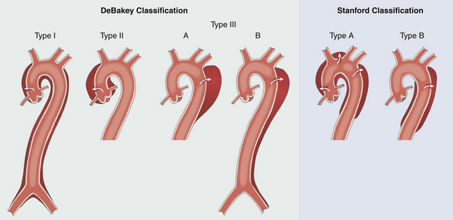 irad aortic dissection classification