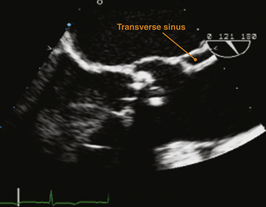 transverse sinus heart