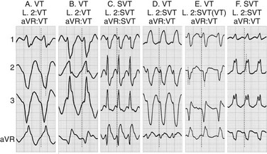 Differential Diagnosis Of Narrow And Wide Complex Tachycardias ...