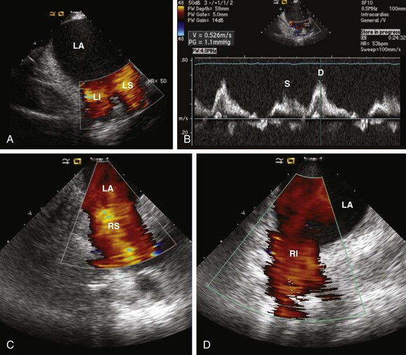 Intracardiac Echocardiography for Electrophysiology | Thoracic Key