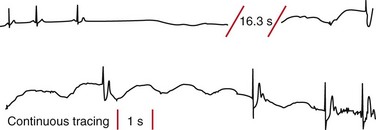 Head-up Tilt Table Testing | Thoracic Key