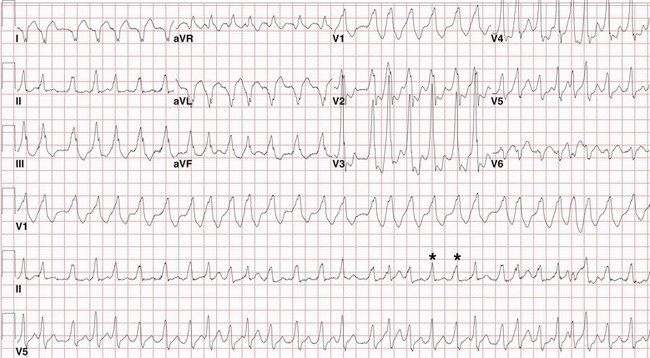 Preexcitation, Atrioventricular Reentry, and Variants | Thoracic Key